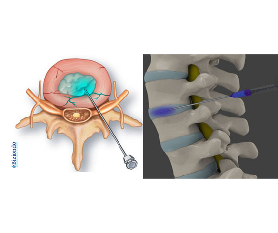 Infiltraciones De Ozono Ozonoterapia Para Hernias Discales Biziondo